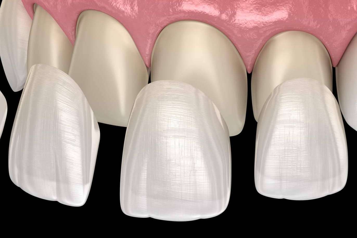 Dentinova, la opción para conseguir una sonrisa Hollywood