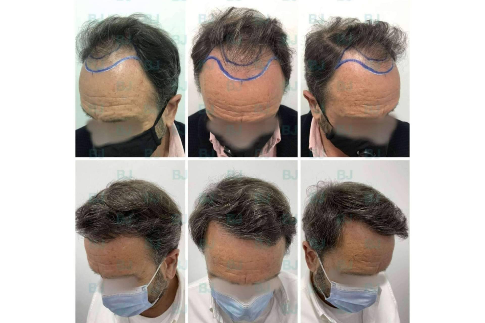 ¿Cuáles son las diferencias de las técnicas de implante capilar FUE y FUSS en la clínica capilar de Dr. Bruno Jacobovski?