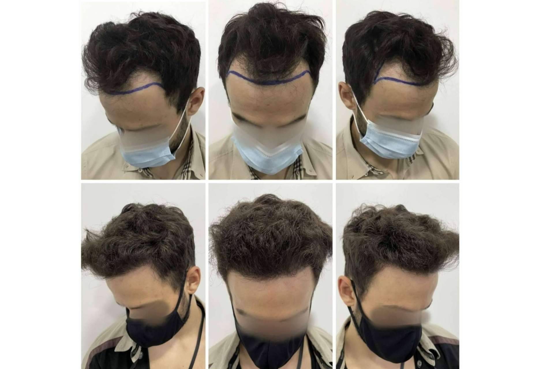 La clínica del Dr. Bruno Jacobovski sortea un trasplante capilar gratis en Barcelona