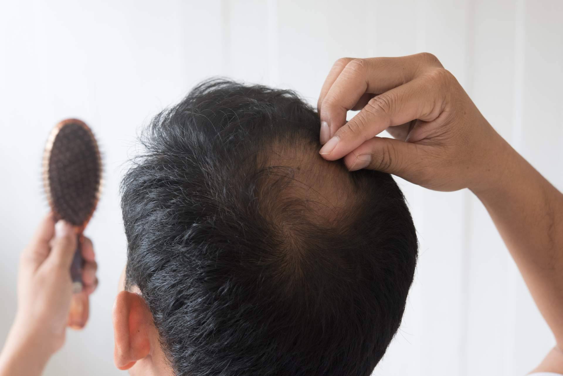 Clínicas Be realiza injertos capilares sin cicatrices