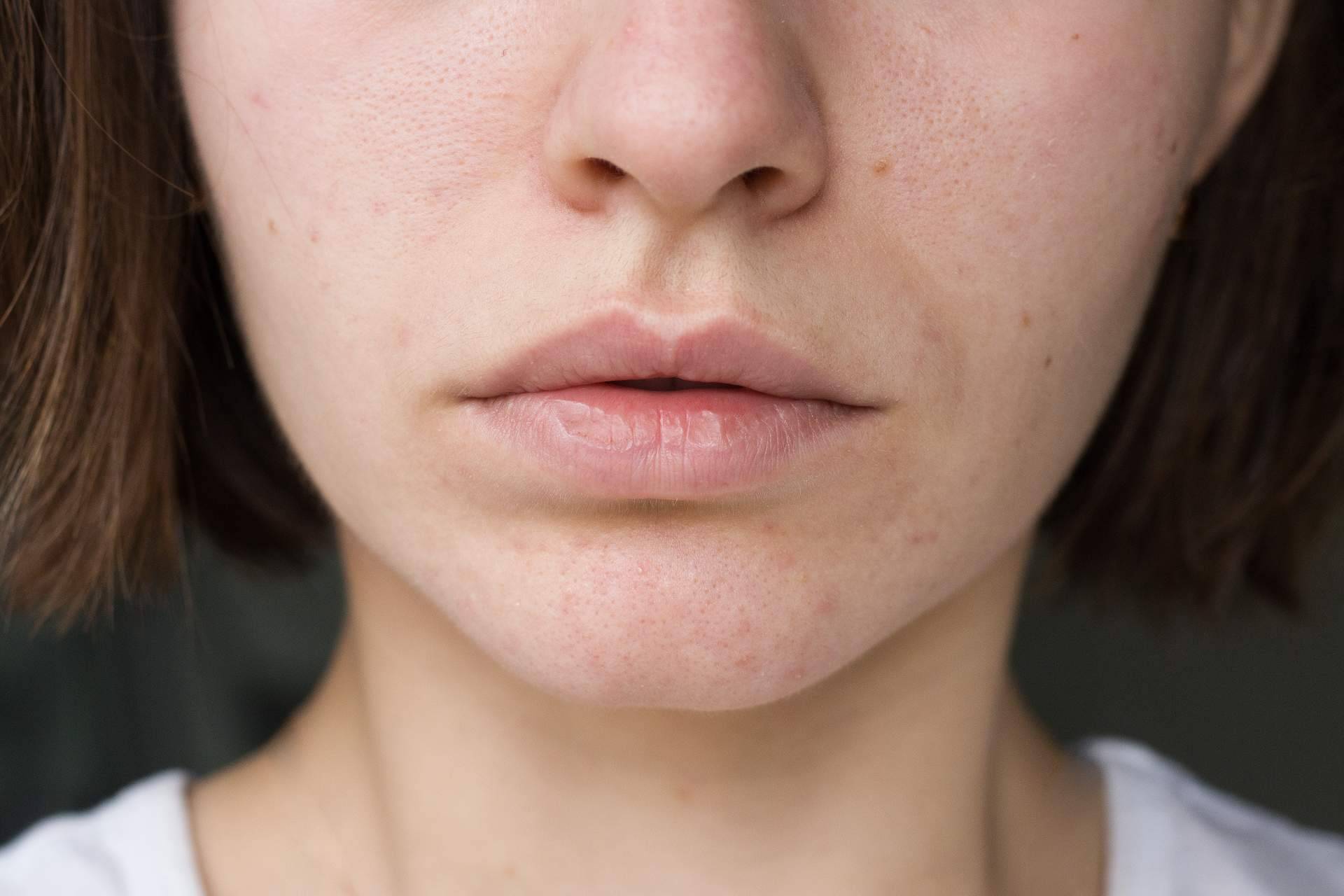 Tratar y prevenir las manchas en la piel en verano, por Farmacia Laura Garín