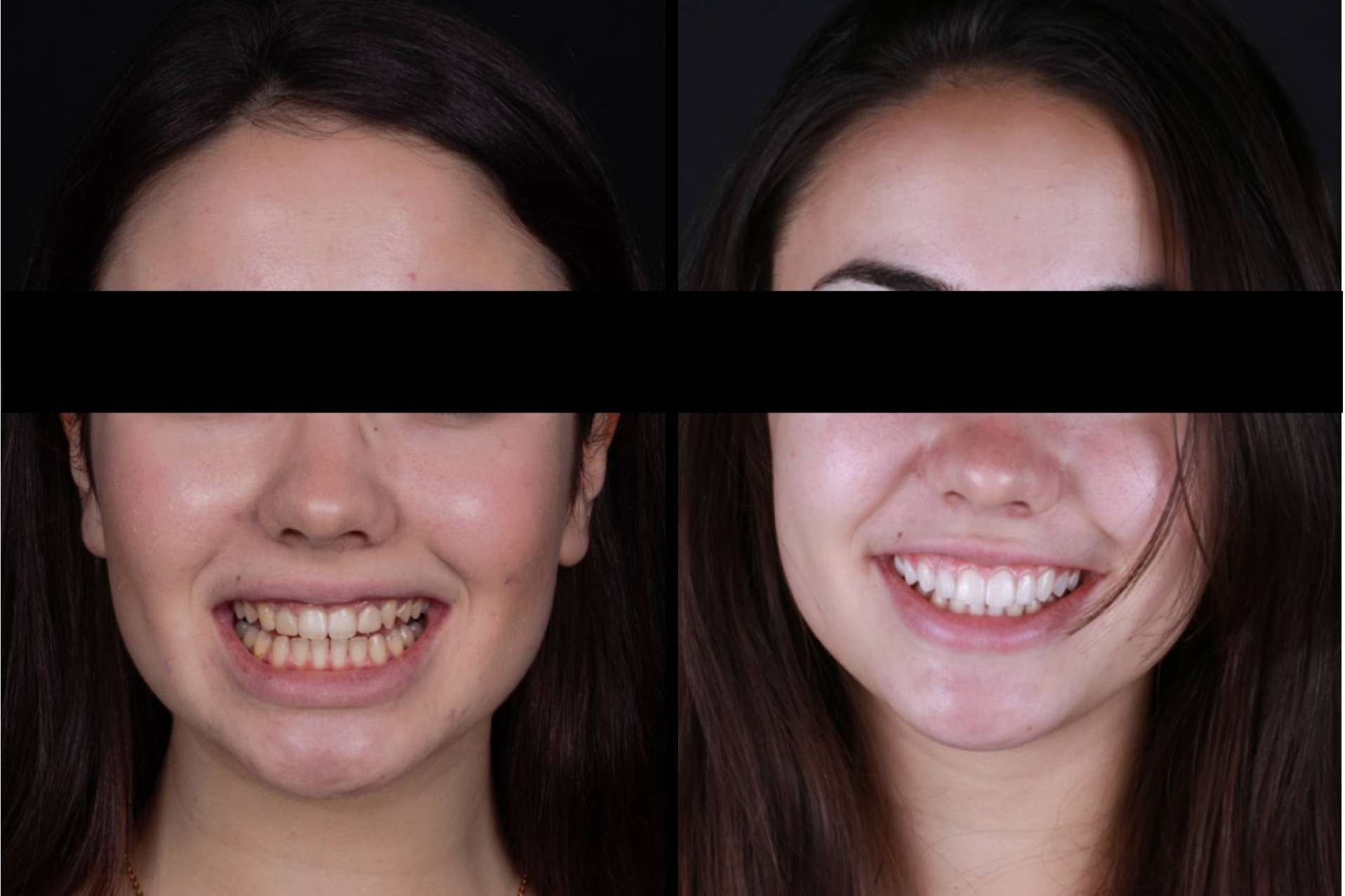 Las ventajas de las carillas dentales, de la mano de los profesionales de Carillas Wikend®