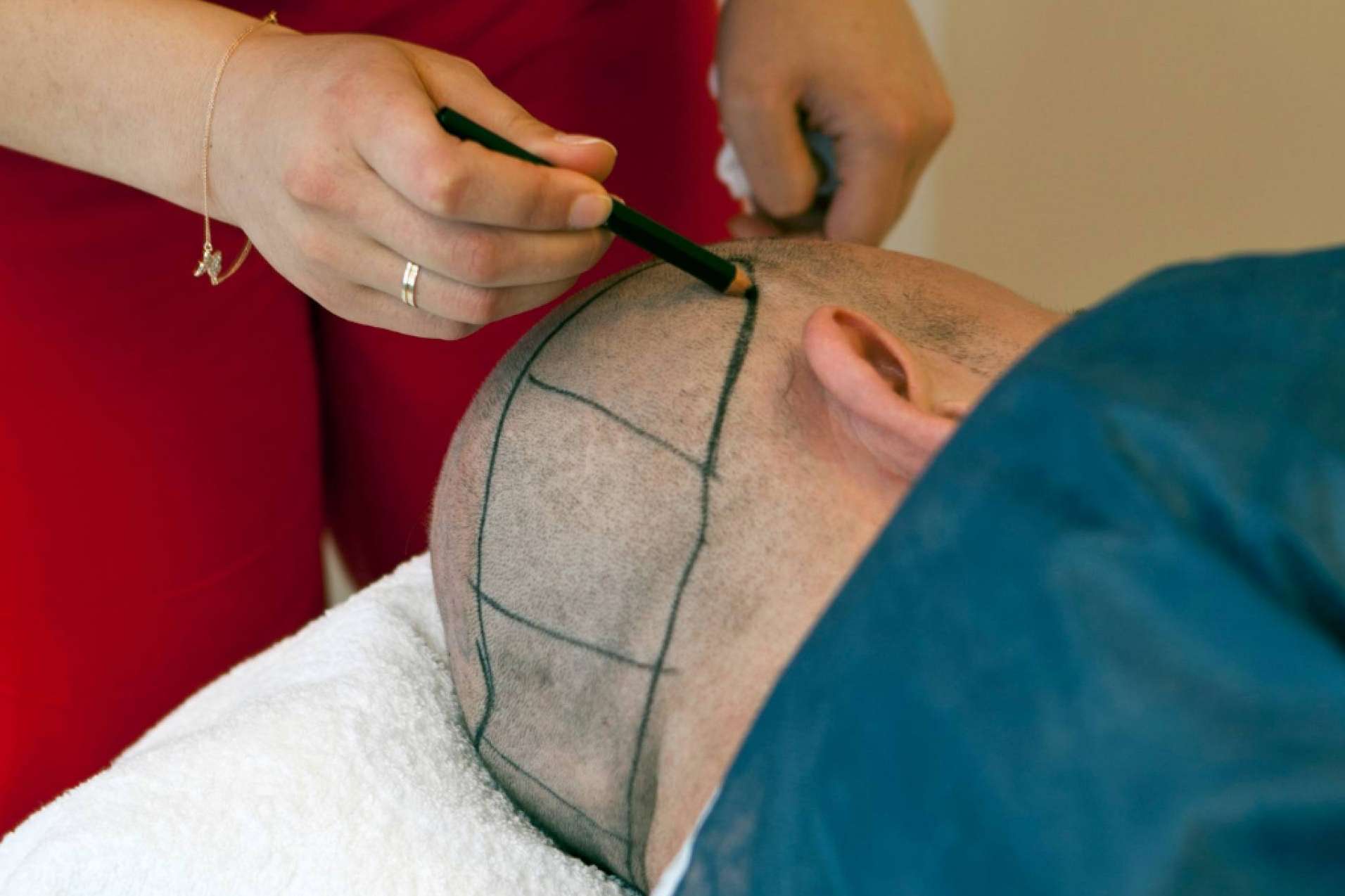 Microcapilar Hair Clinic ofrece tratamientos de microinjerto capilar en Madrid, de la mano del Dr. Antonio Fernández Brito