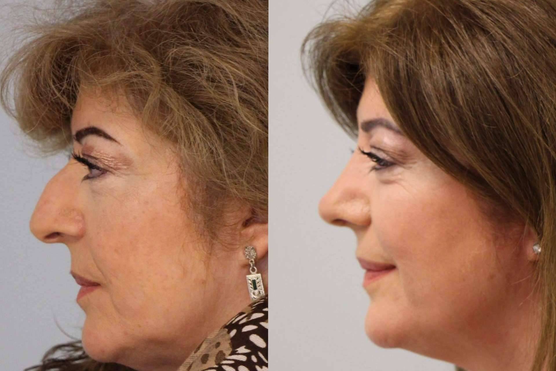 El Dr. Pérez Villar aconseja qué hacer antes de pasar por una rinoplastia ultrasónica