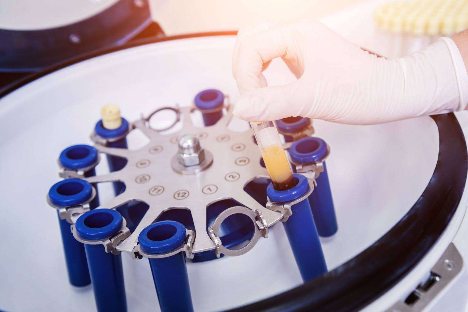 La potente terapia regenerativa de doble efecto basada en plasma rico en plaquetas y dutasterida contra la caída del cabello