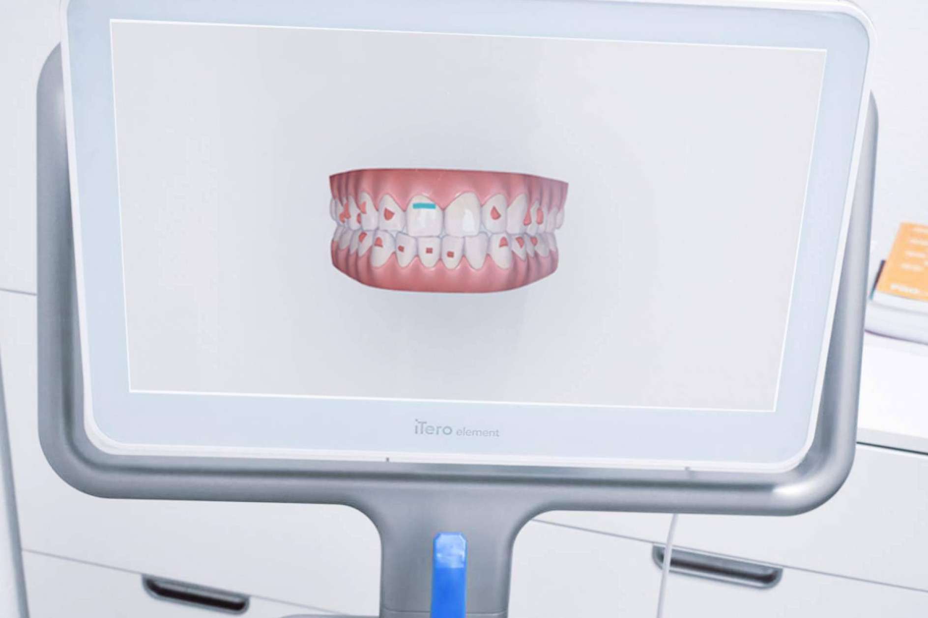 La ortodoncia invisible Invisalign es el sustituto perfecto a los brackets