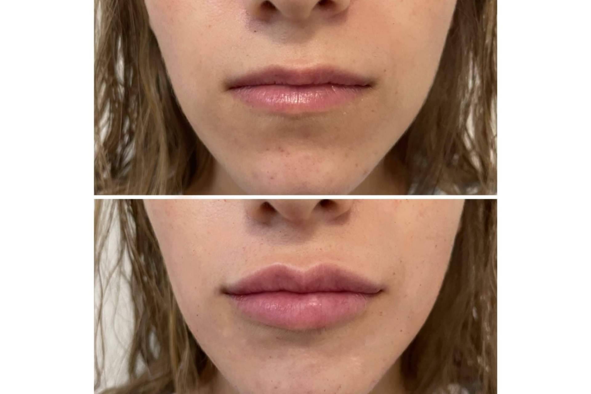 ¿Es posible realizarse un aumento de labios en Madrid con resultados naturales?, por la Dra. Cecilia Arthur