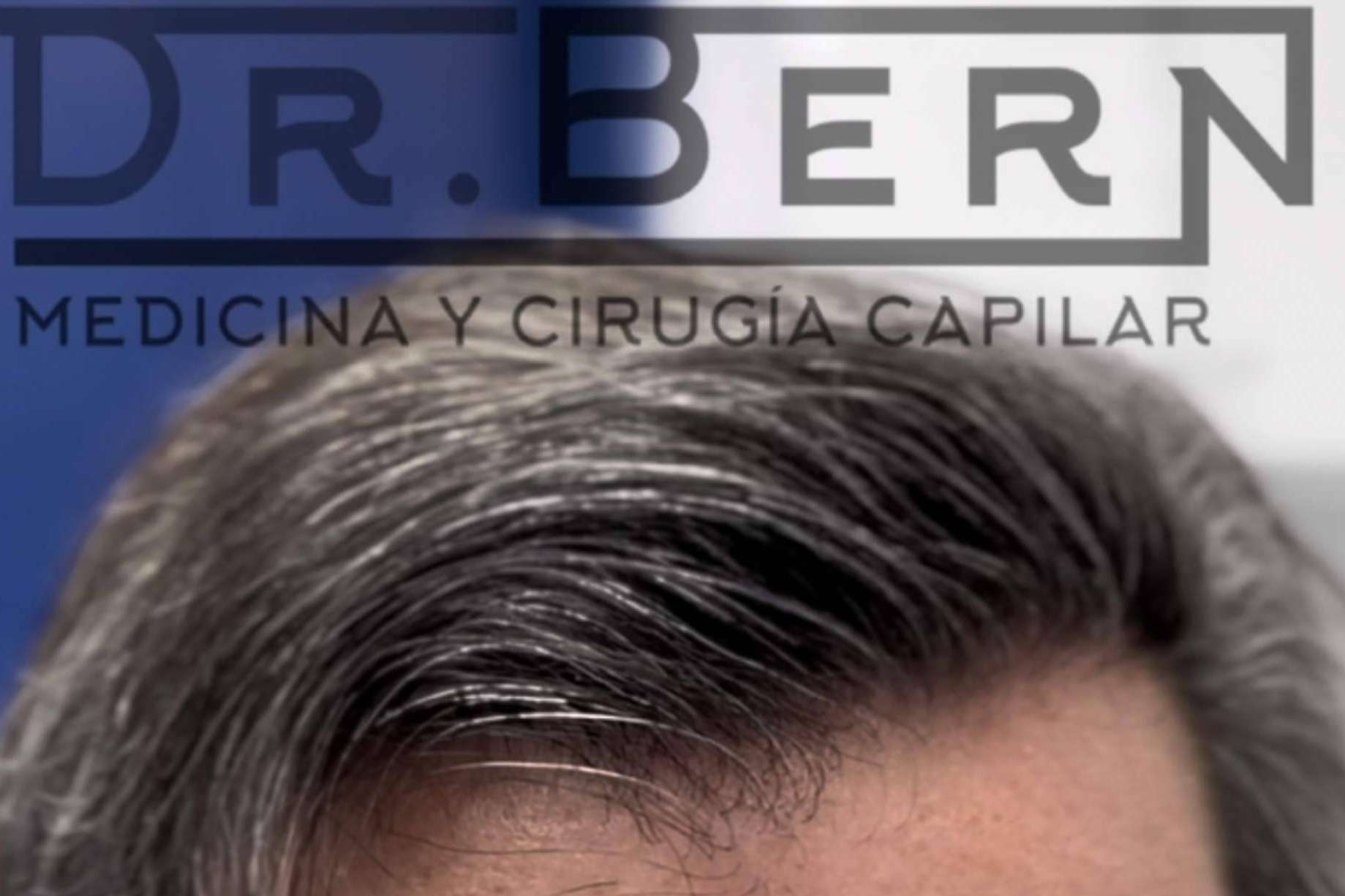 Dr. Bern perfecciona la técnica FUE - DHI y lleva su técnica alrededor de Latinoamérica y Europa
