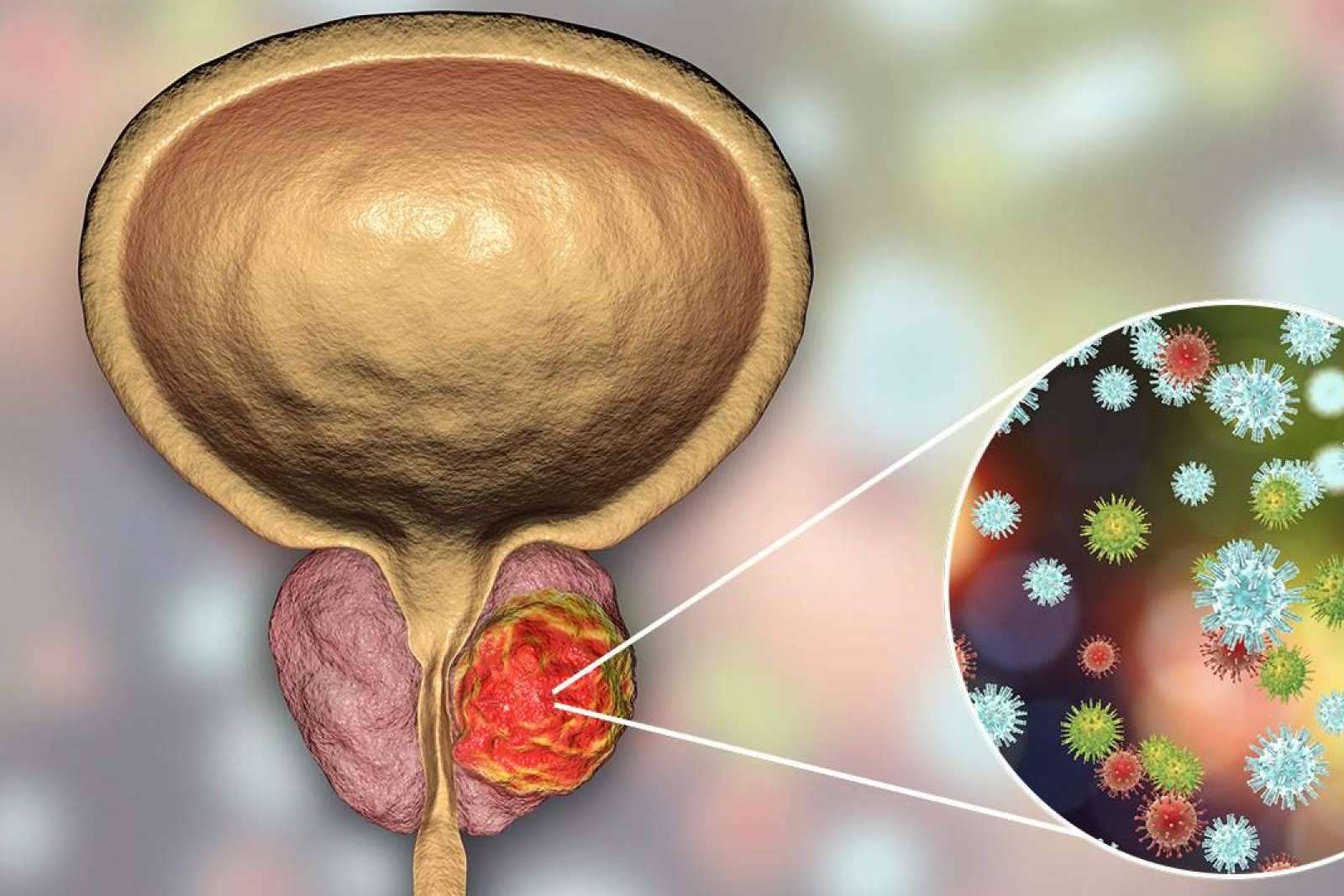Capenergy afirma que superar las consecuencias de un cáncer de próstata es posible