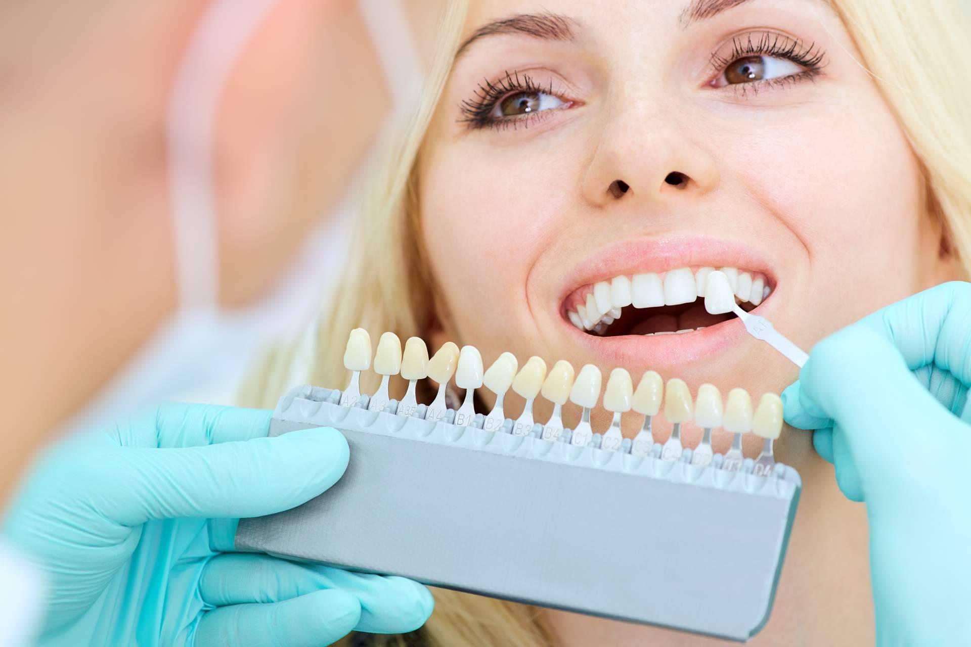 Todo sobre el tratamiento de carillas dentales en esta clínica dental de Chamartín