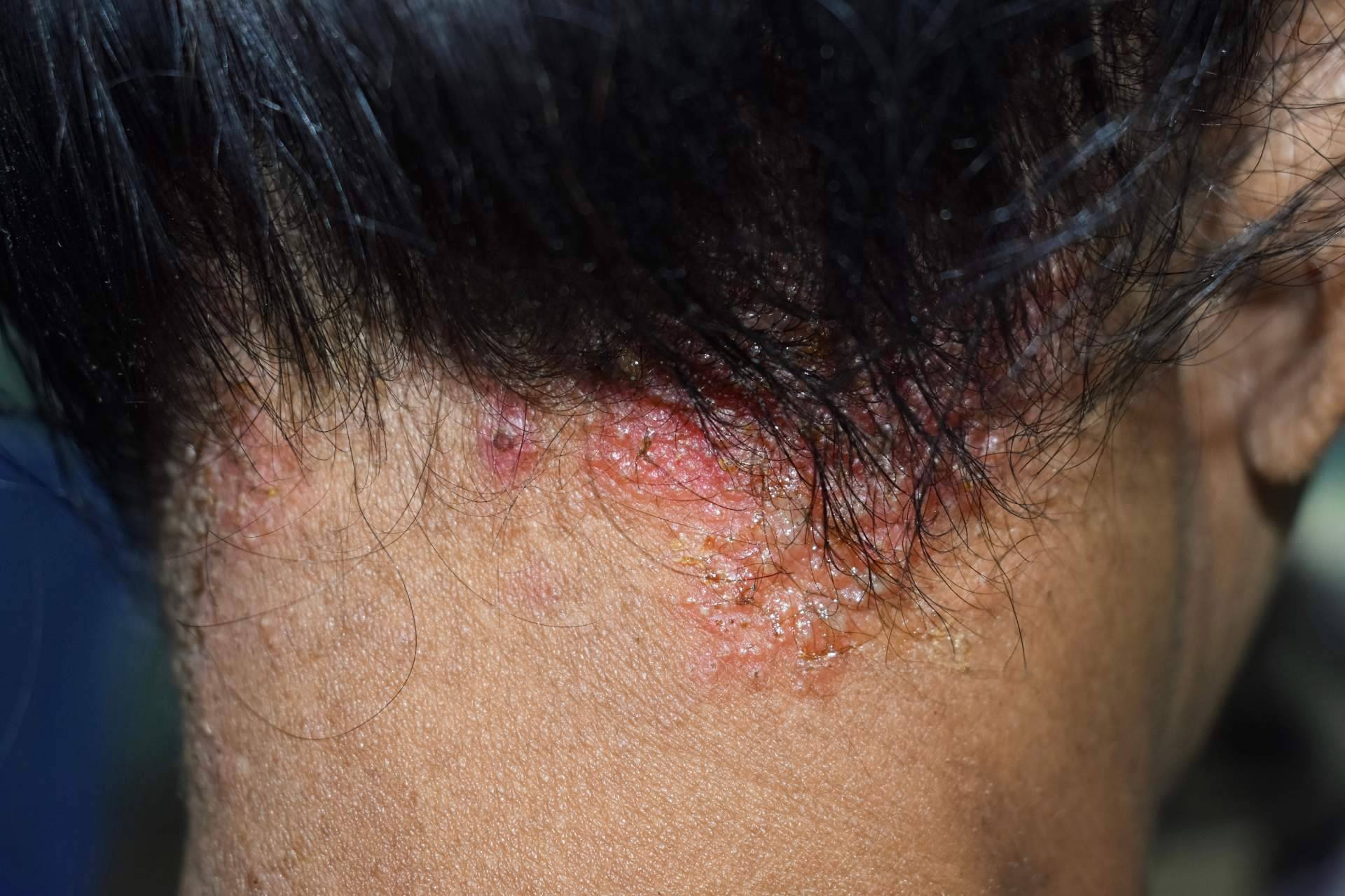 Dermatitis seborreica es una afección que puede generar alopecia si no se trata