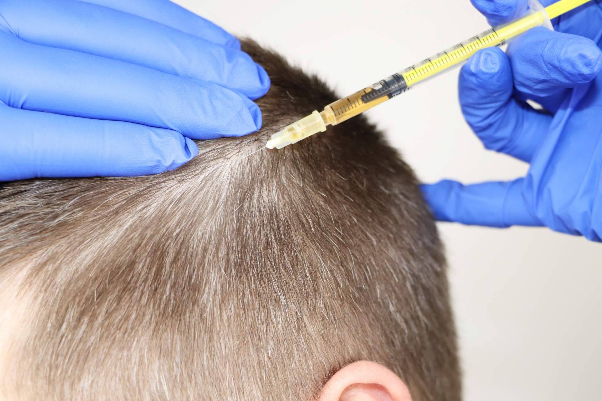 ¿Cuáles son las ventajas de la mesoterapia capilar Madrid?, con Crina Rus Beauty Center