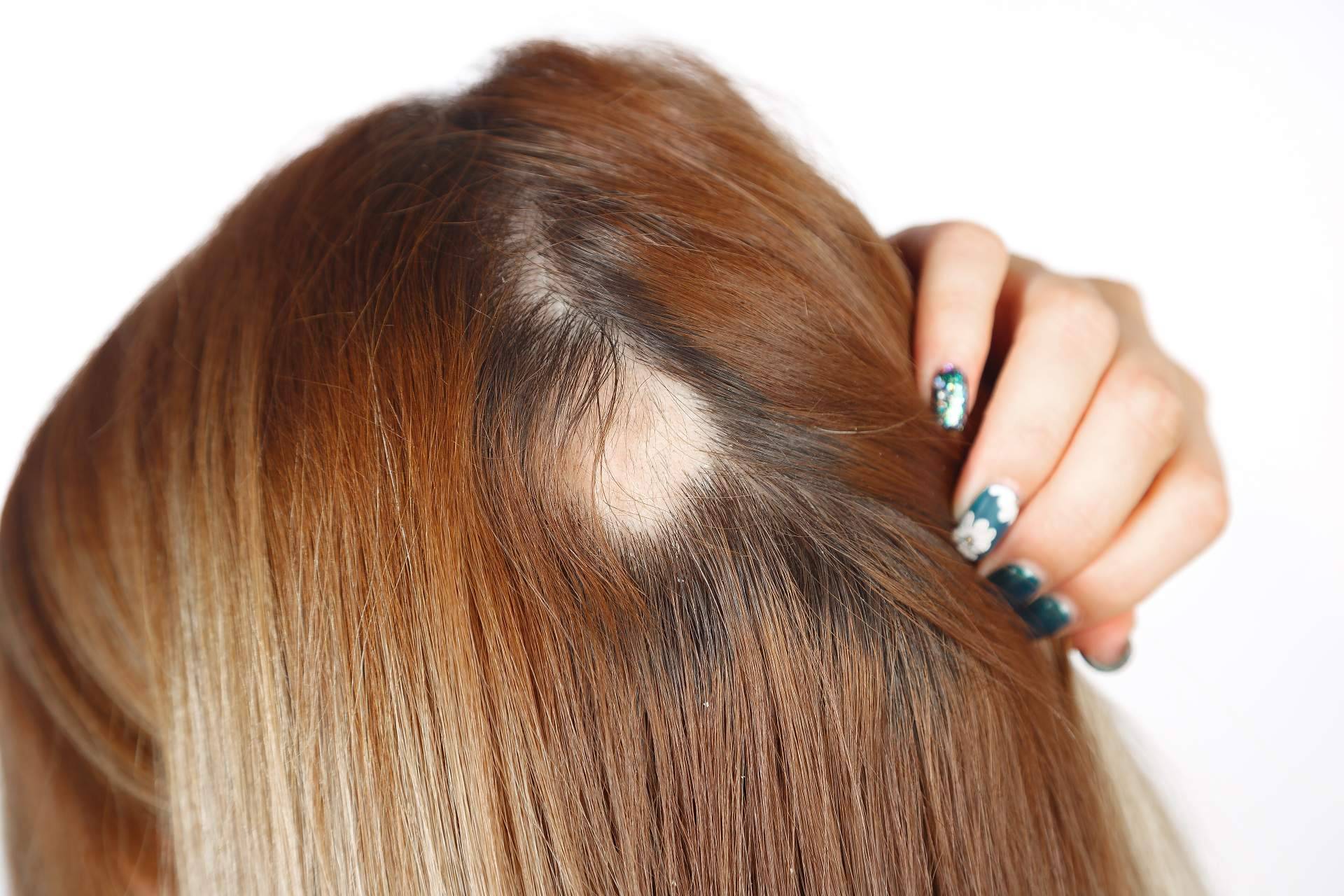 Especialistas en cualquier tipo de alopecia femenina en la clínica Capilar Innovation Clinic