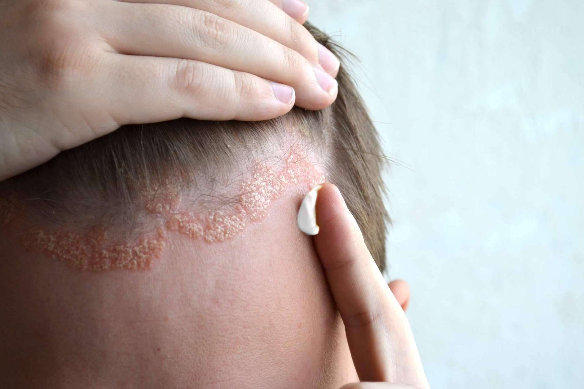 La Fundación Piel Sana de la AEDV quiere resaltar los riesgos que hay sobre la psoriasis en cuero cabelludo