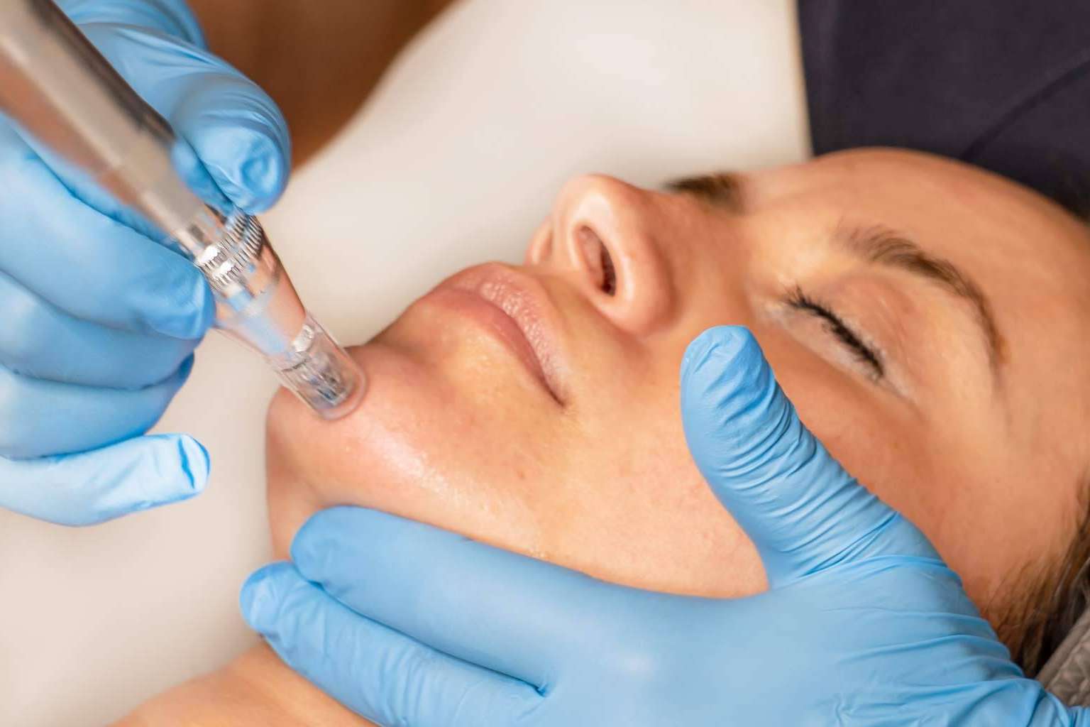 Tratamiento innovador Dermapen Madrid en G&G Beauty