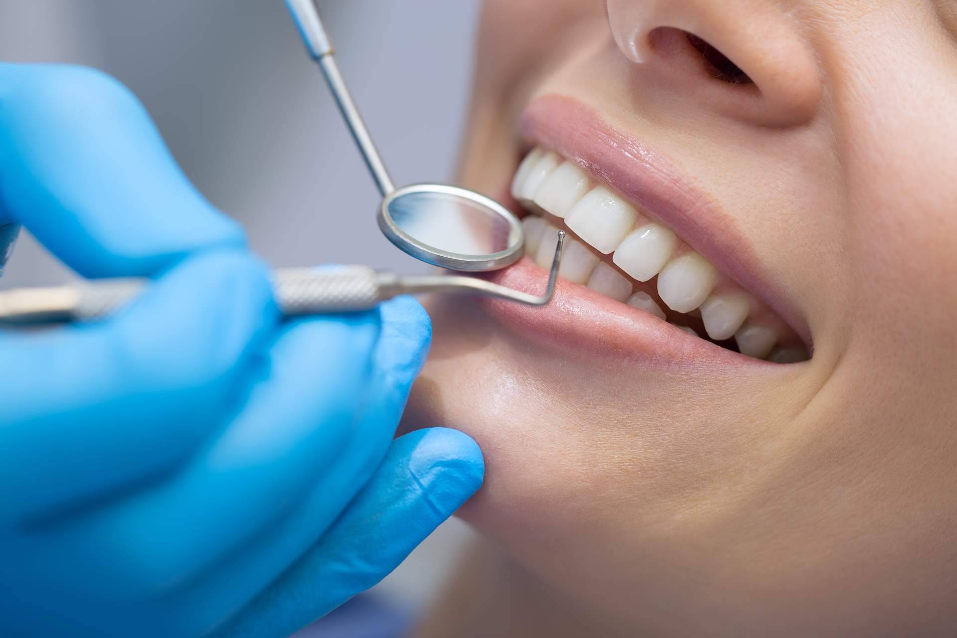 ¿Qué soluciones ofrecen las carillas dentales?