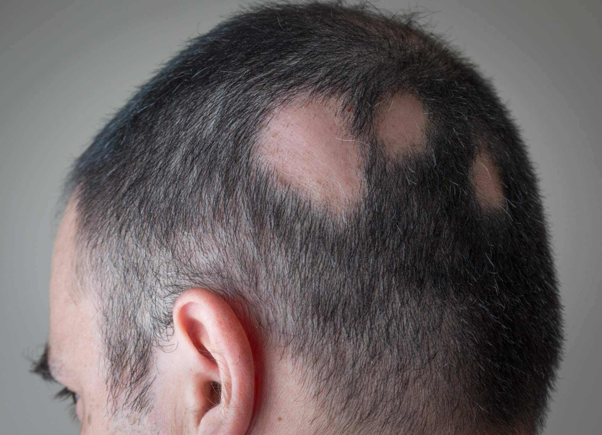 ¿Qué es la alopecia areata y cómo disimularla?
