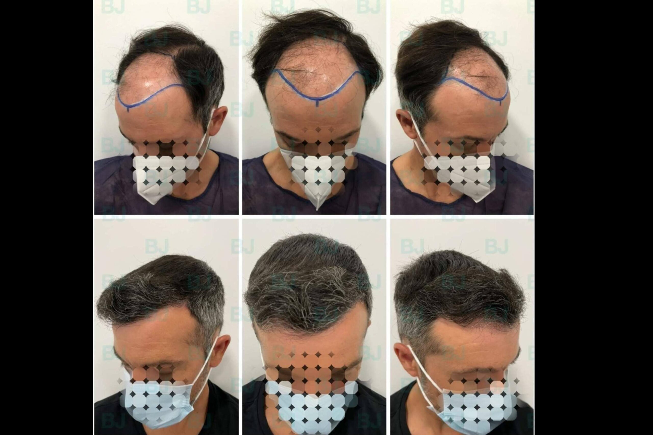 El Dr. Bruno Jacobovski utiliza las técnicas más modernas a la hora de realizar un tratamiento capilar