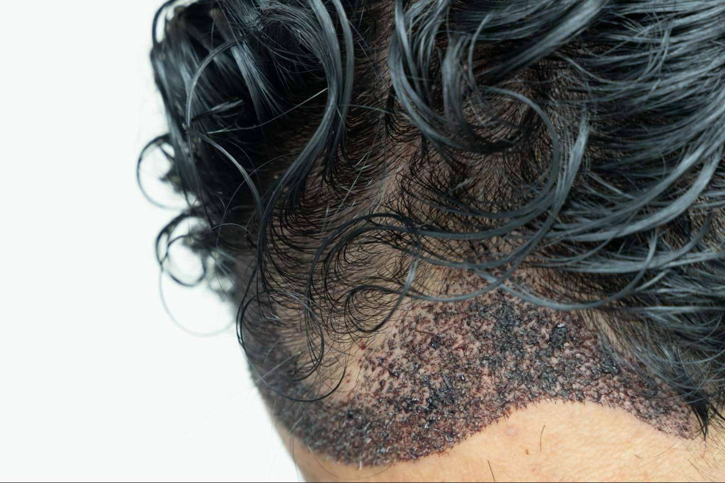 Microinjerto capilar para hombres en verano, con Capilar Innovation Clinic