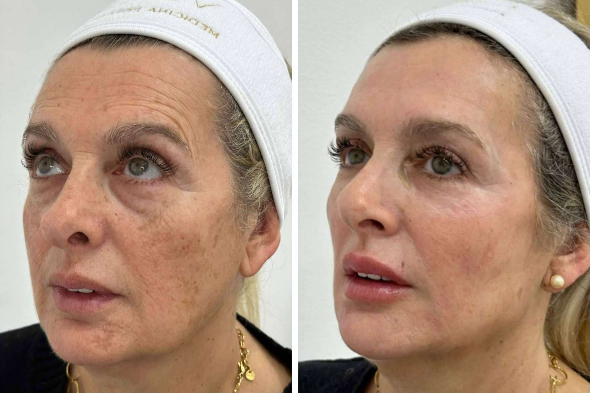 Clínica VISO sobre cómo combatir la flacidez facial