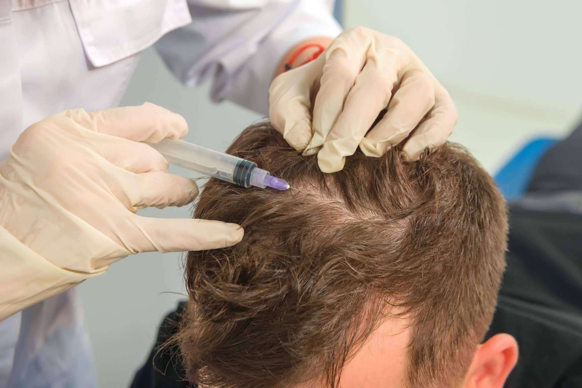 Cuáles son las ventajas de realizarse un tratamiento de mesoterapia capilar de IMD para recuperar las condiciones óptimas del cabello
