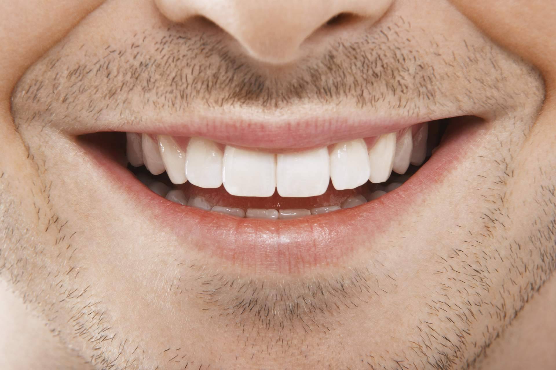 Qué son las carillas de composite, por Carlos Saiz Smile