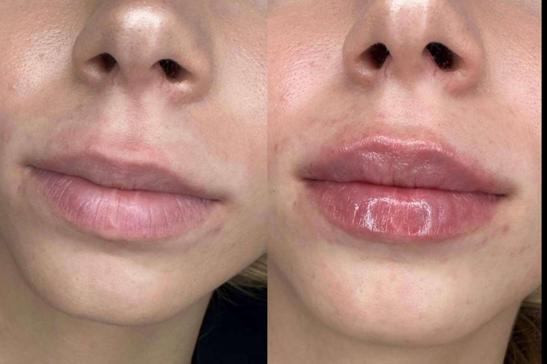 La doctora Sandra Hermida explica en qué consiste su técnica de dos pasos para lograr unos labios 100 % naturales