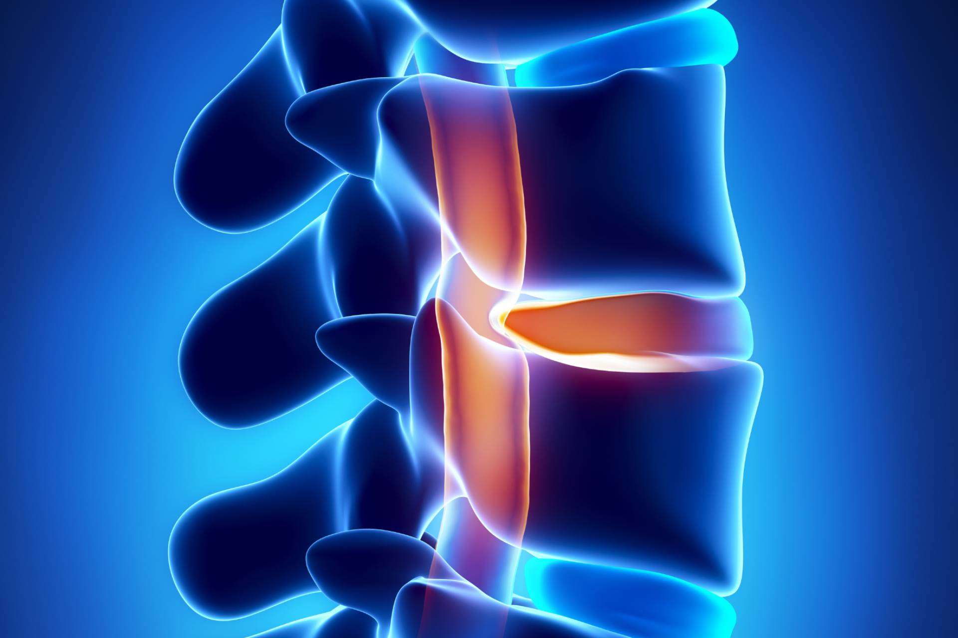 Tratar la hernia discal con andulación, un novedoso enfoque terapéutico