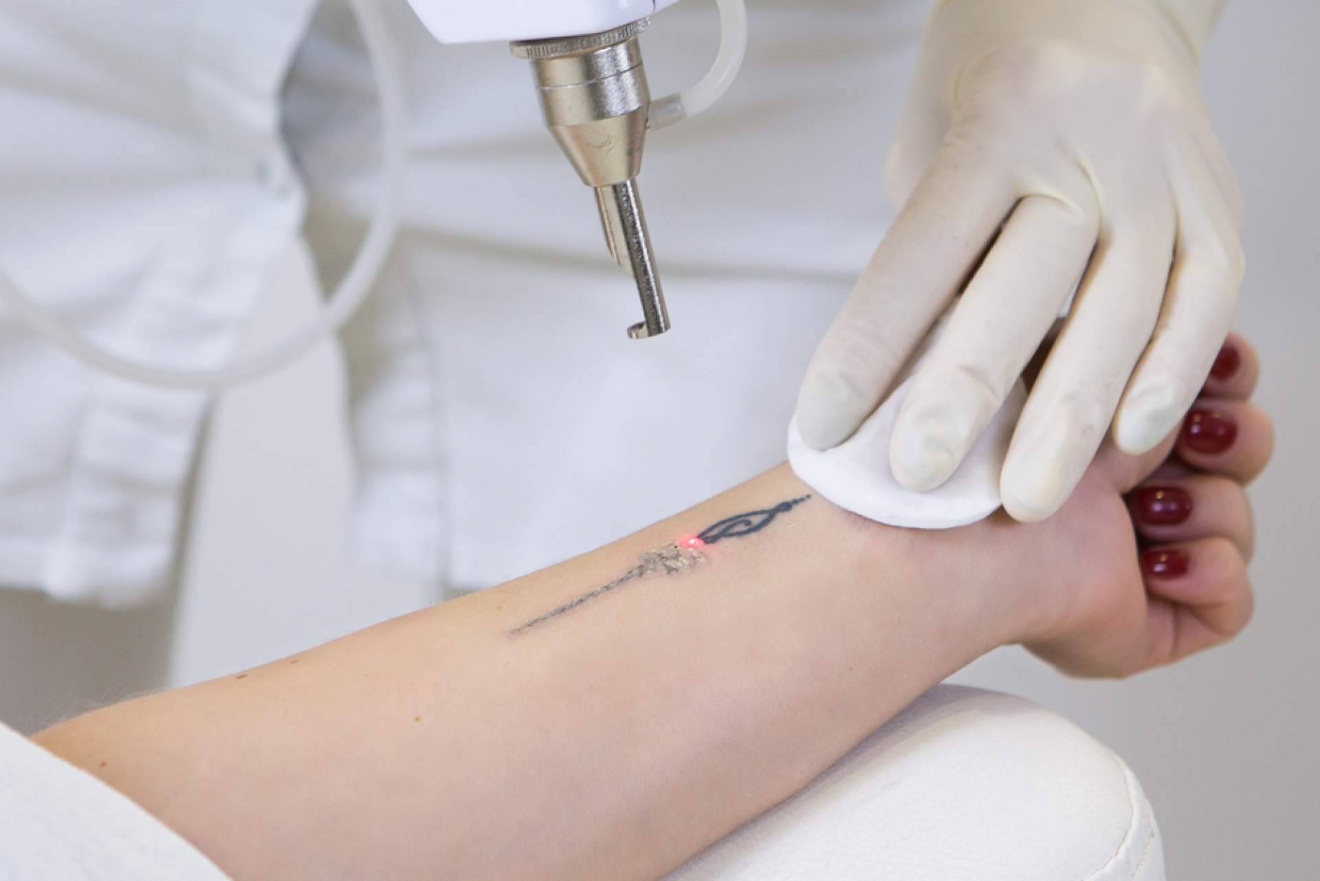 Centro Médico El Pilar cuenta con las últimas tecnologías para la eliminación de tatuajes