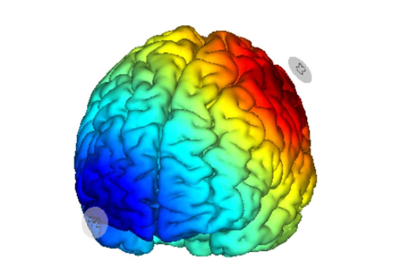 Avances en el tratamiento de la fibromialgia mediante estimulación cerebral no invasiva