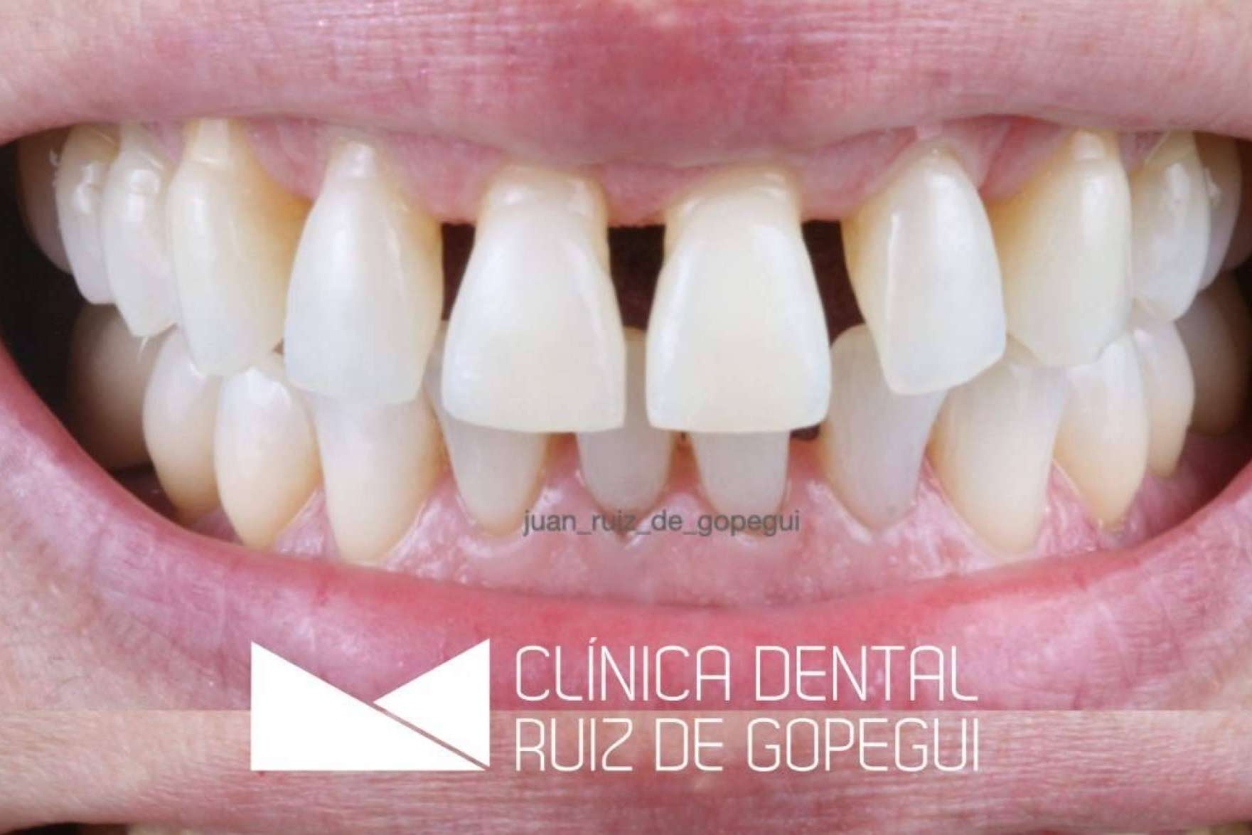 Tratamiento de la periodontitis para combatir la enfermedad silenciosa