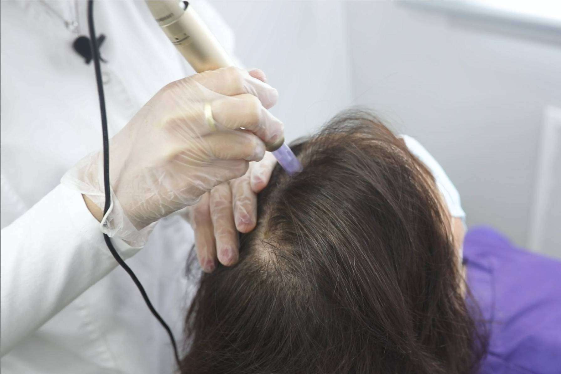 IMD cuenta con más de 20 años poniendo solución a la alopecia areata