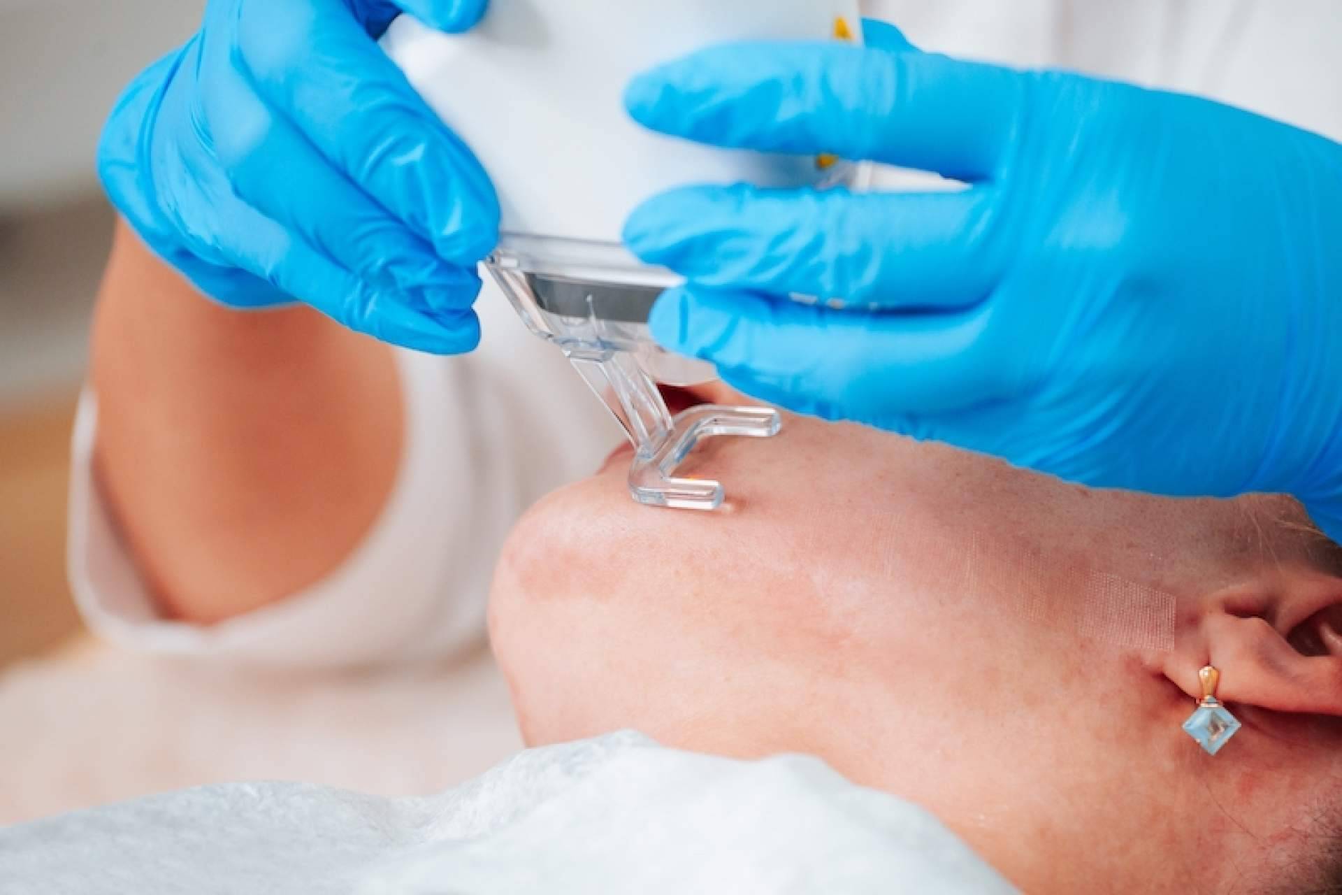 ¿Cuáles son las ventajas de usar tratamientos para eliminar cicatrices?, por Centro Estética el Pilar