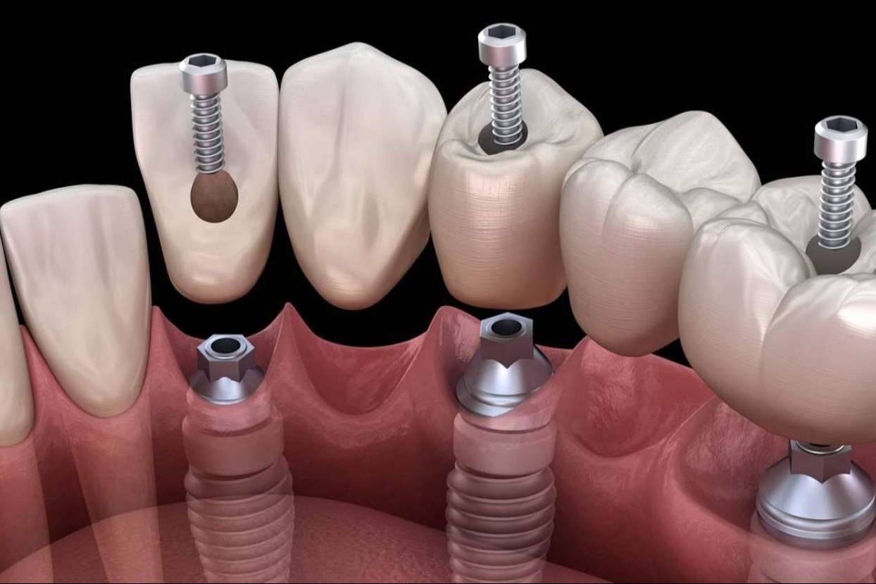 El servicio de colocación de implantes de Dental Implantologie