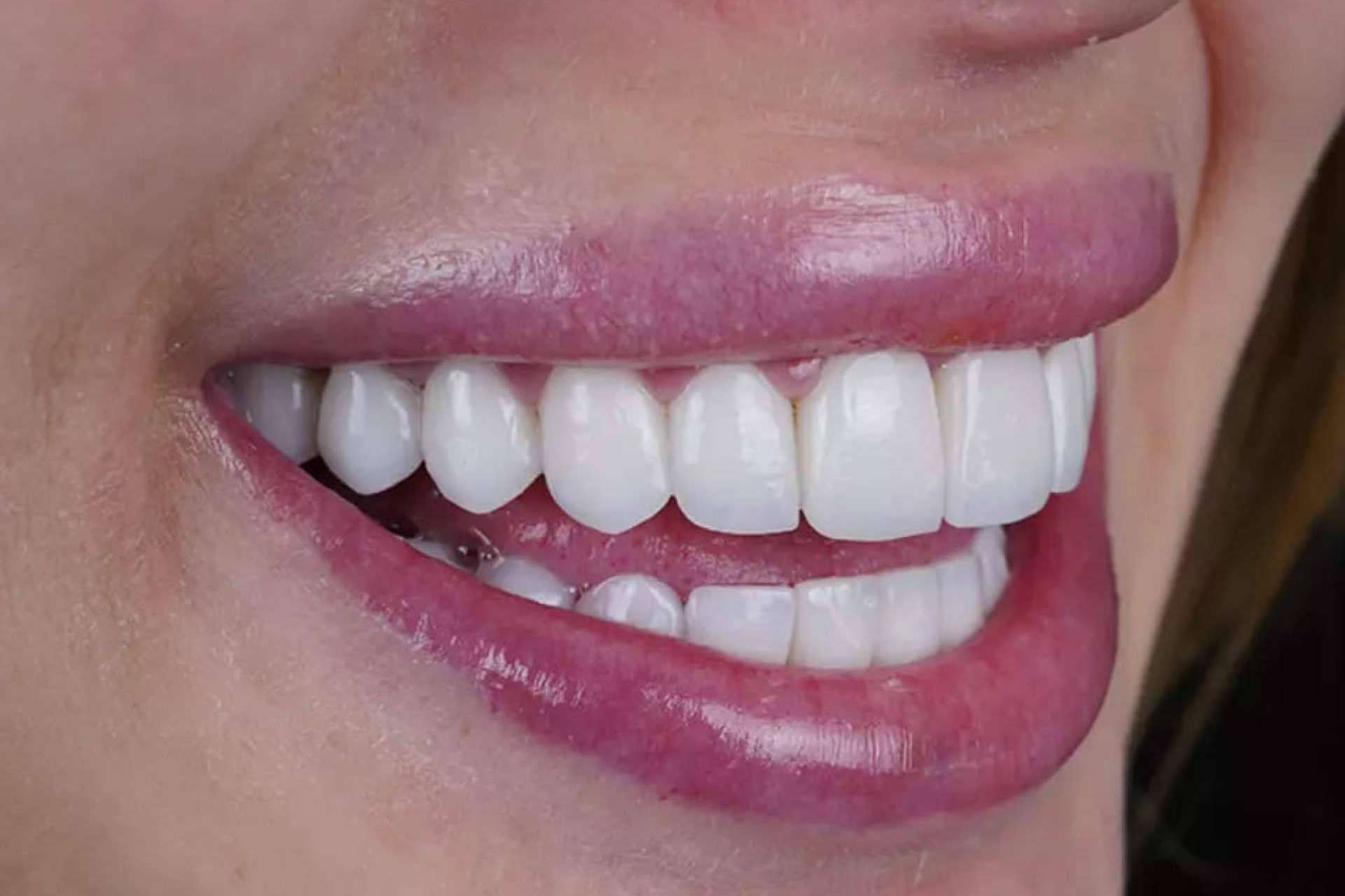 Denty Dent ayuda a mejorar la sonrisa con tratamientos de estética dental