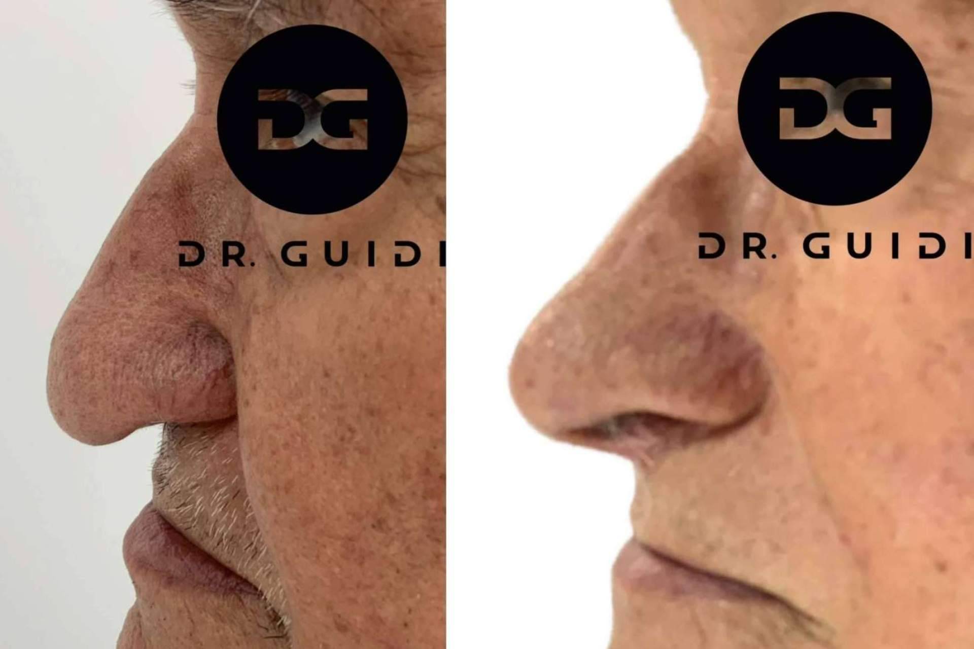 La clínica del Dr. Guidi ofrece tratamientos de rinomodelación