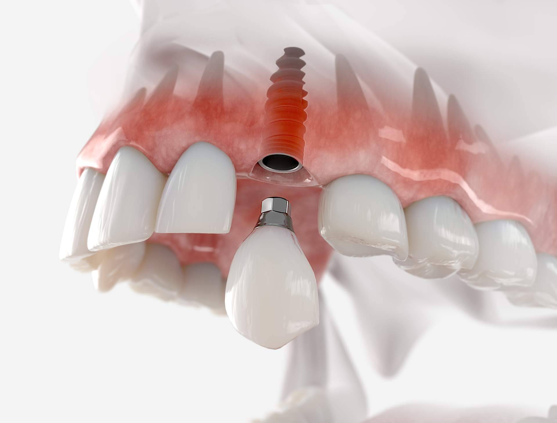 Cuáles son los beneficios de los implantes dentales, por DeltaDent