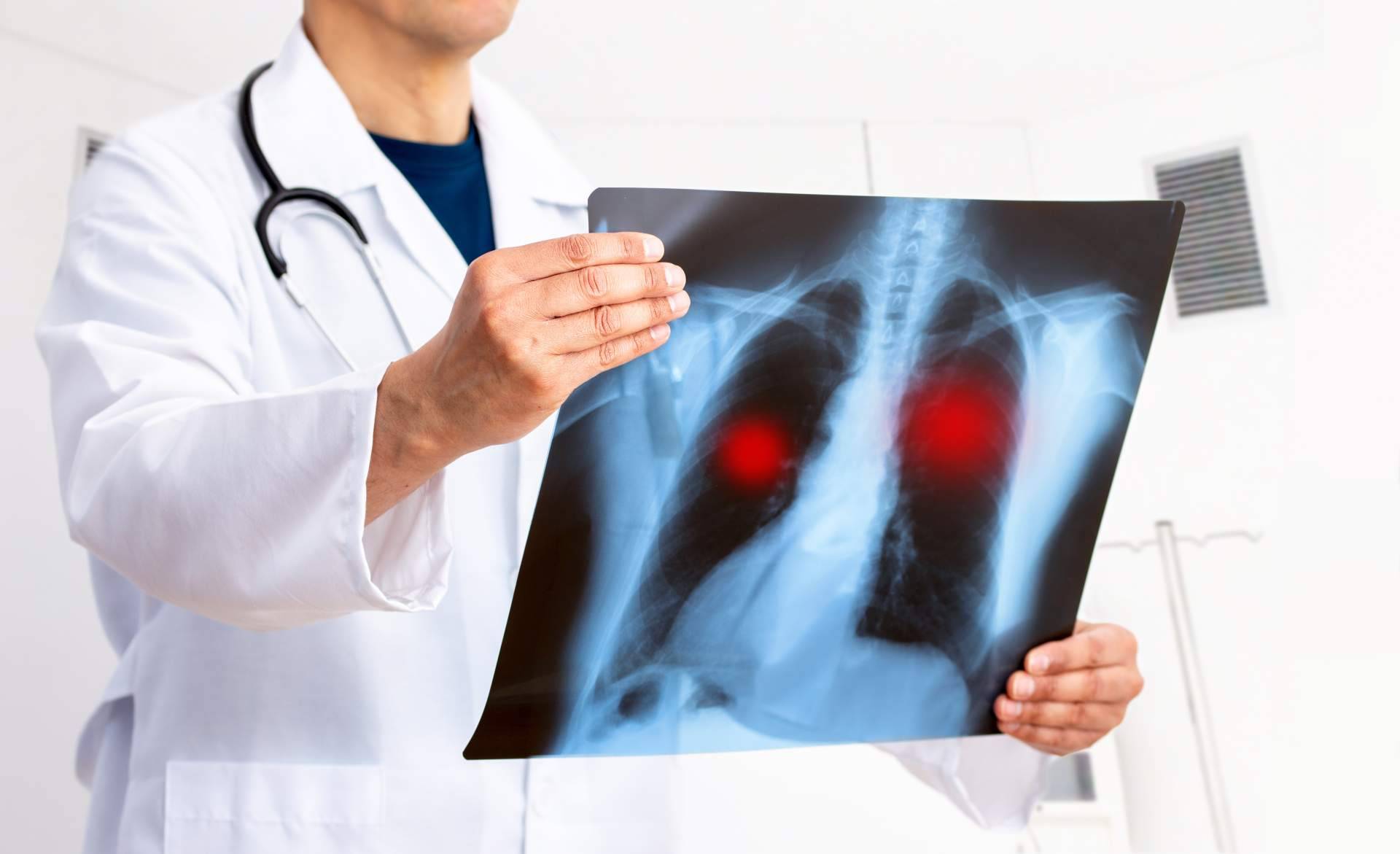 Todo sobre el tratamiento de cáncer de pulmón con Oncothermia (Nanothermia)