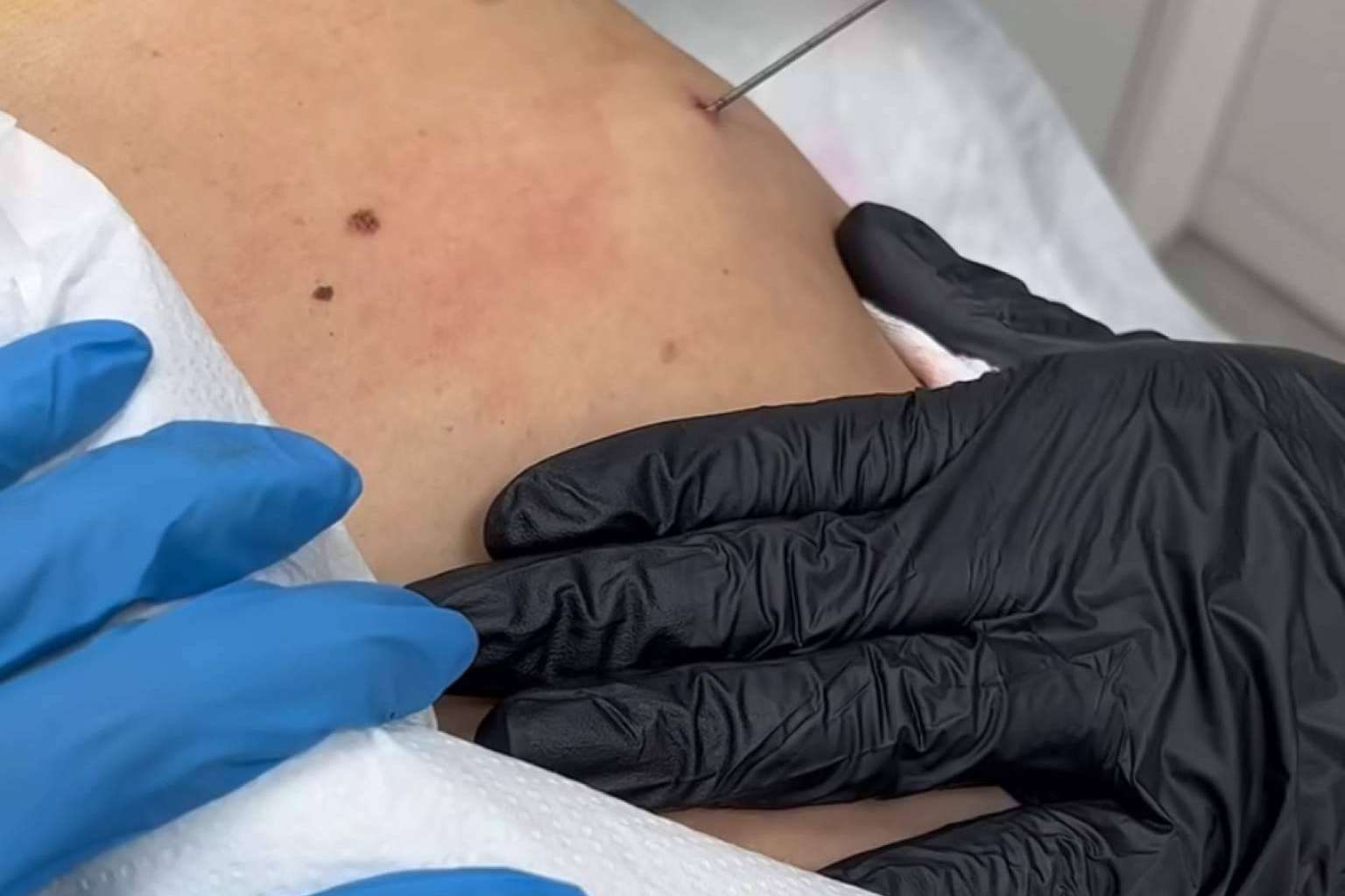 Endolif para reducción de grasa corporal y facial, por Capilar Innovation Clinic