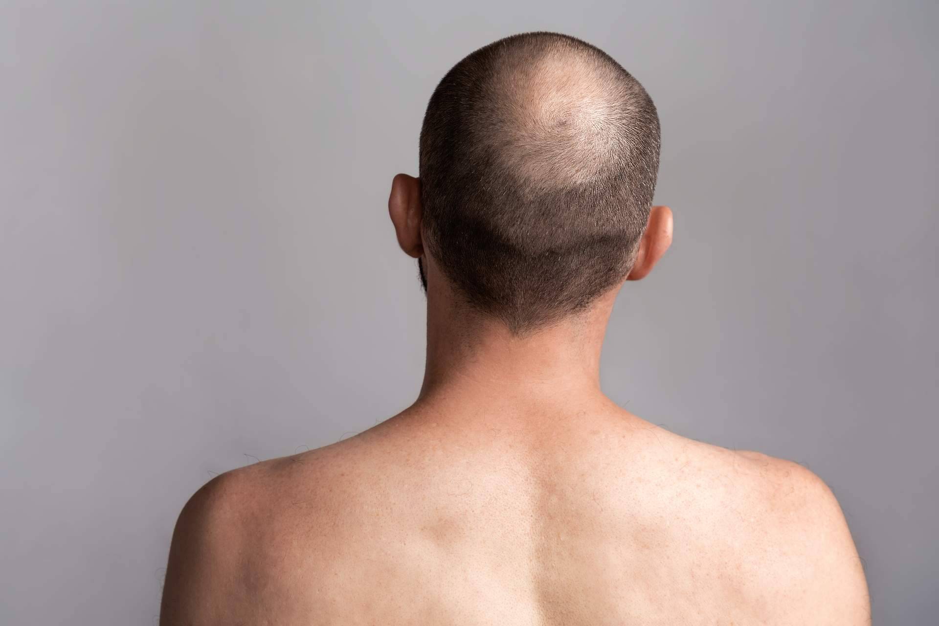 Saw Palmetto y los tratamientos para la alopecia androgénica