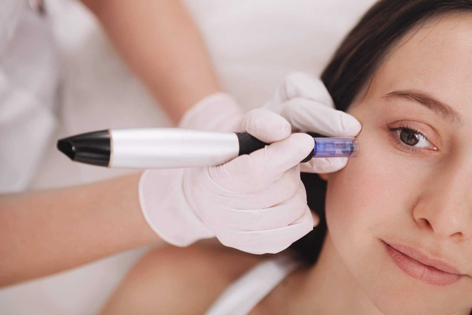 Tratar pequeñas cicatrices y mejorar el aspecto de la piel con dermapen en ojeras y en cicatrices de G&G Beauty