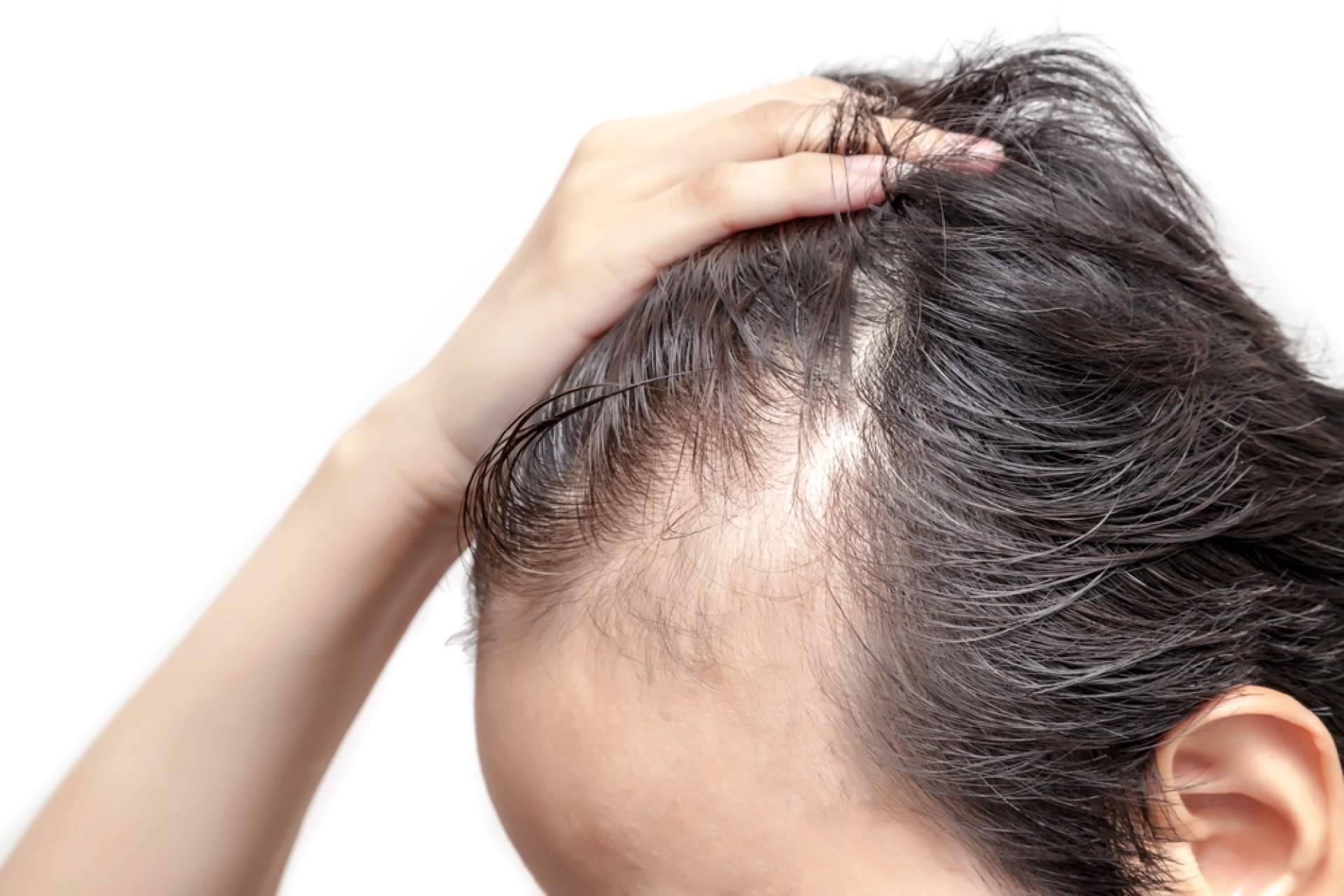 Someterse a los tratamientos para la alopecia androgénica de Saw Palmetto