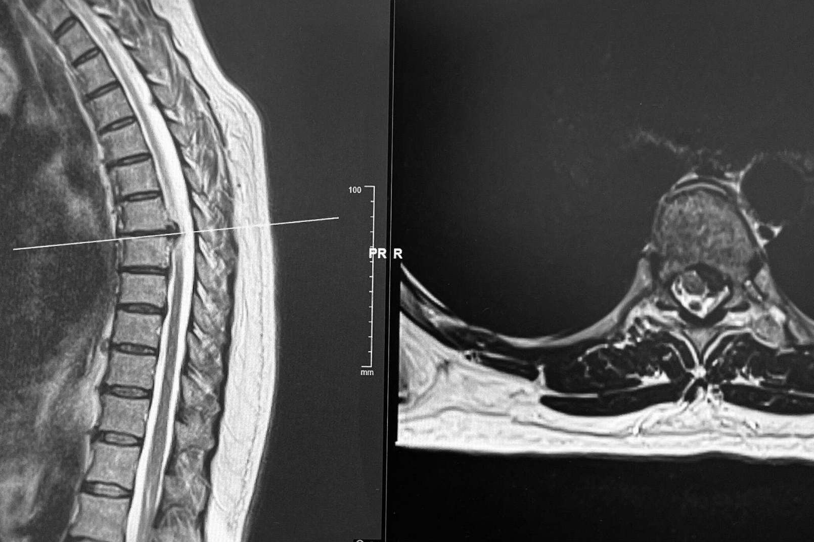 Dr. Carlos Botella-Asunción, neurocirujano especialista en cirugía de hernia discal