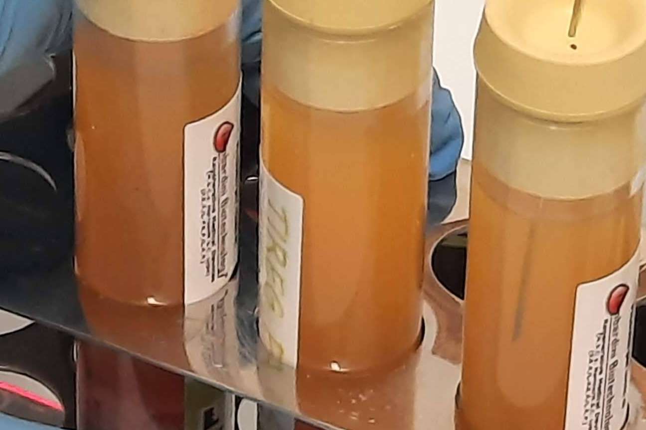 Un tratamiento eficaz sin cirugía para artrosis de rodilla, las infiltraciones de plasma rico en plaquetas y células madre