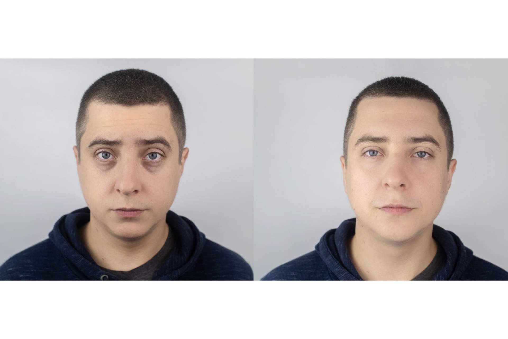 Combatir las ojeras con ácido hialurónico; el tratamiento no invasivo de Centro Estética El Pilar