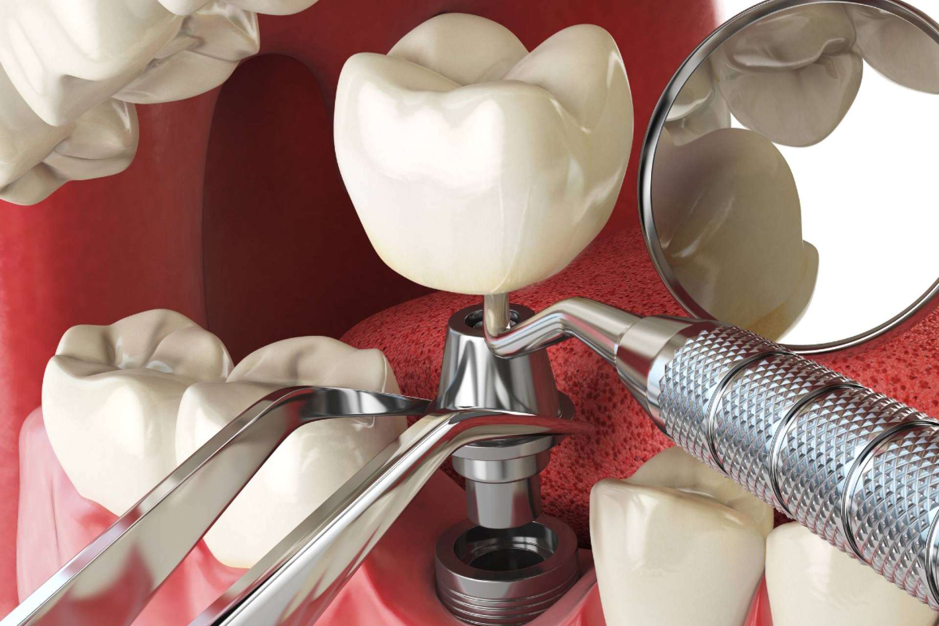 Denty Dent en Madrid presenta el estándar de calidad en implantes dentales