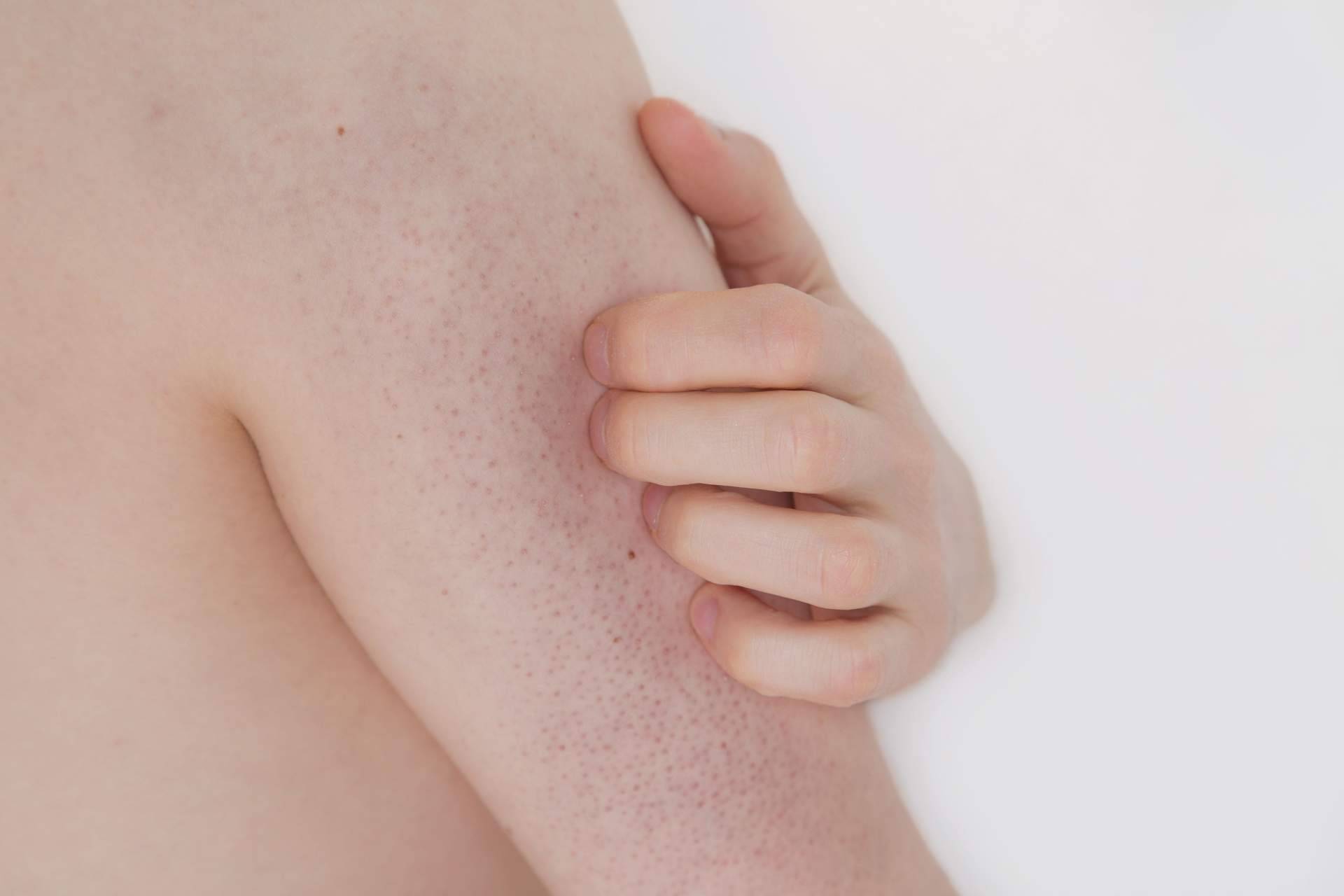 Consejos profesionales de la Dra. Janeth Arévalo para atenuar la queratosis pilaris