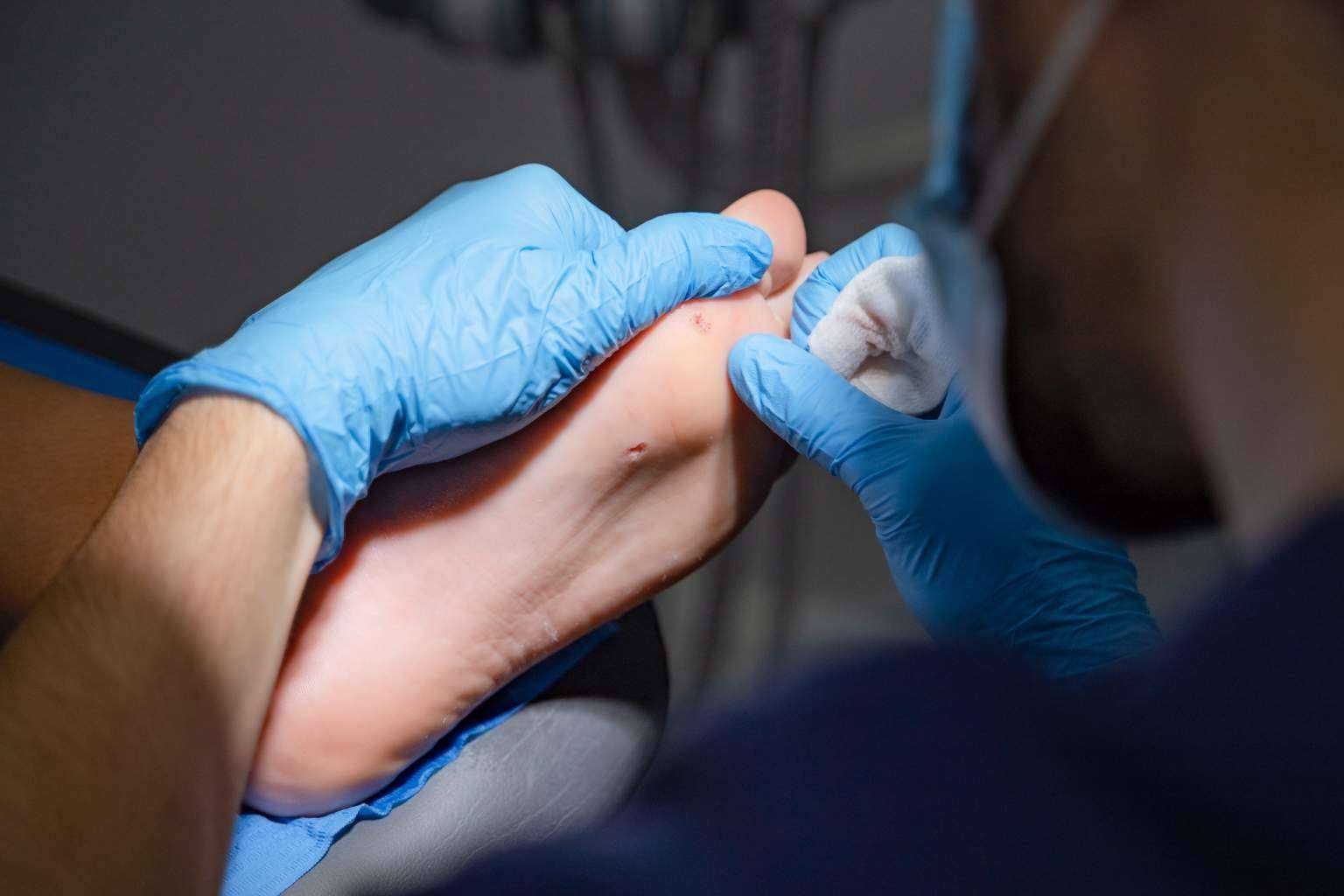 Diferentes tratamientos contra el papiloma plantar de la mano de DM Clínica