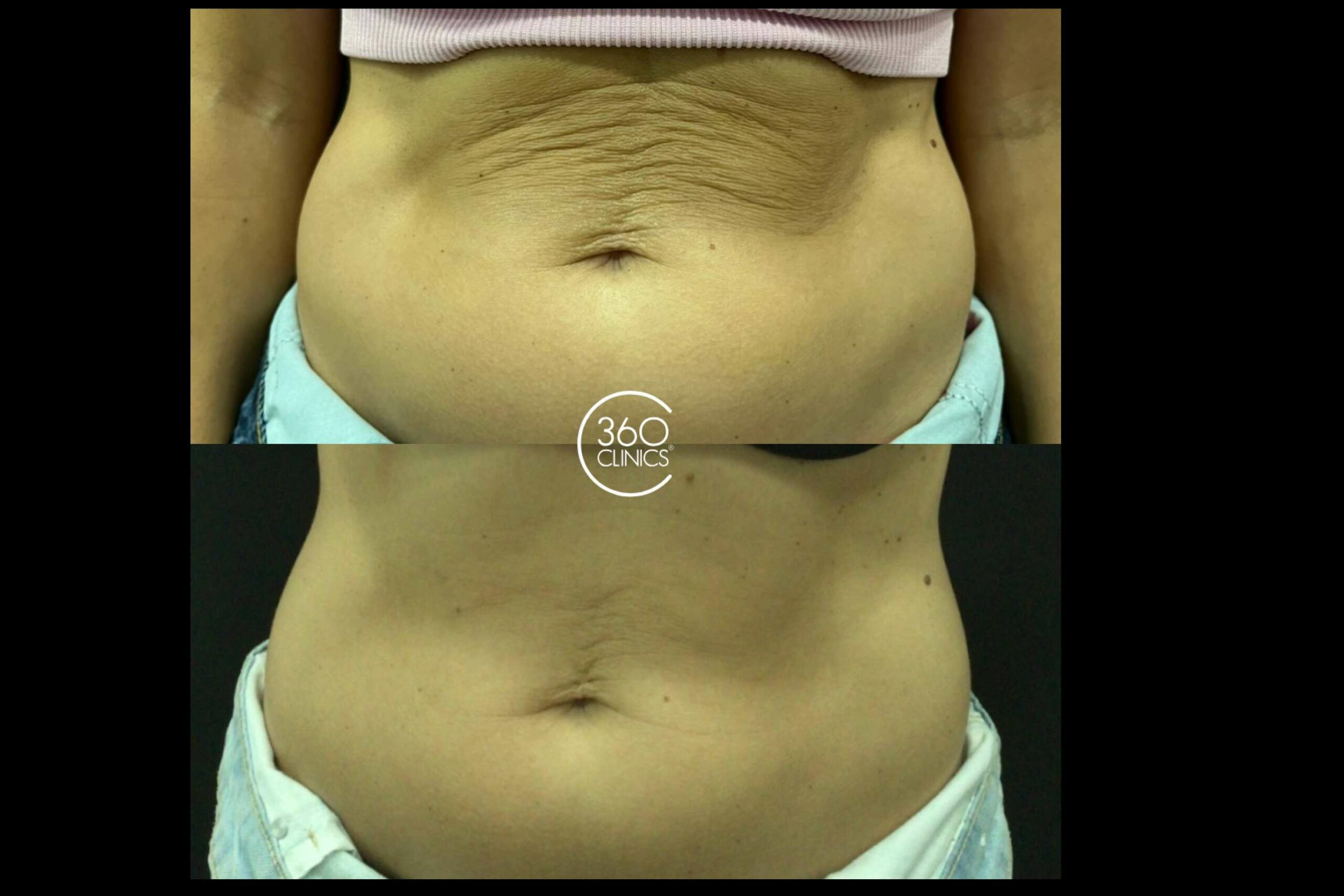 360 Clinics, revoluciona el sector de la estética con el innovador tratamiento Philart corporal