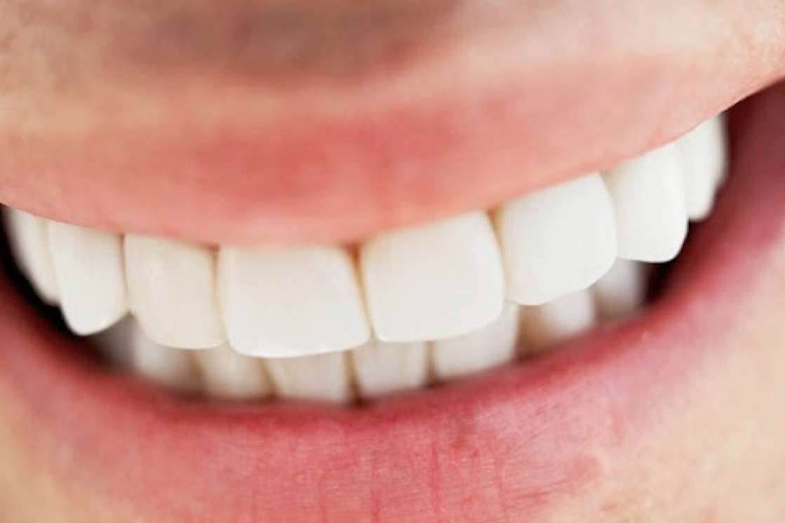 Prótesis fija estética de zirconio; la apuesta de Clínica Dental Jorge del Corral por la calidad y la estética dental